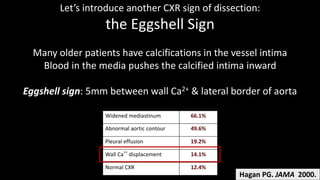 Eggshell Radiology EMGuideWire's Radiology Reading Room: Aortic Dissection | PPTX