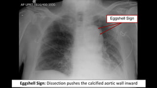 Eggshell Radiology EMGuideWire's Radiology Reading Room: Aortic Dissection | PPTX