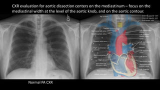 CXR evaluation for aortic dissection centers on the mediastinum – focus on the
mediastinal width at the level of the aorti...