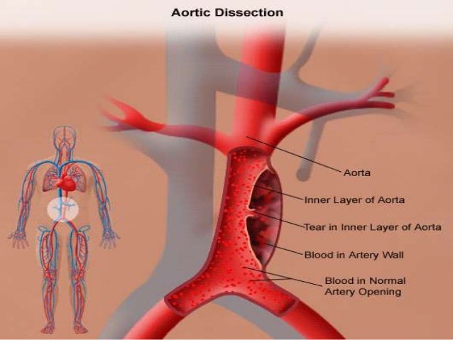 Aortic Dissection Nikhil