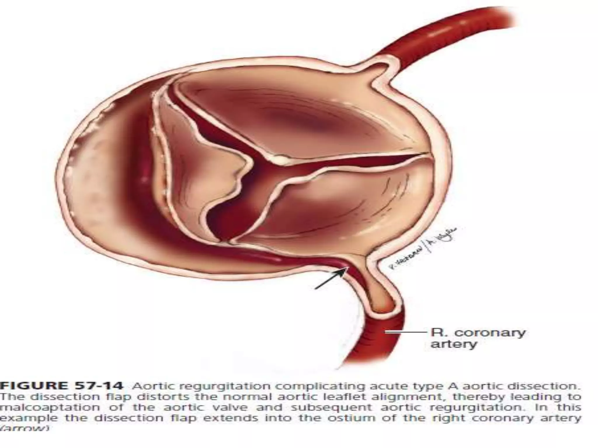 Aortic dissection ppt | PPTX