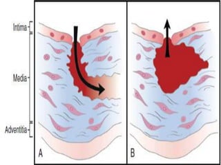 Aortic dissection ppt | PPTX