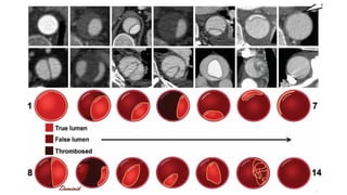 Dissection Classification Class Imaging in Aortic Dissection - classification, findings, complications ...