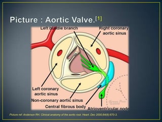 Picture ref: Anderson RH. Clinical anatomy of the aortic root. Heart. Dec 2000;84(6):670-3.

 