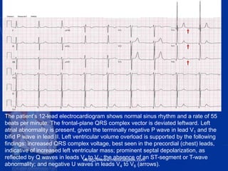 The patient’s 12-lead electrocardiogram shows normal sinus rhythm and a rate of 55
beats per minute. The frontal-plane QRS complex vector is deviated leftward. Left
atrial abnormality is present, given the terminally negative P wave in lead V1 and the
bifid P wave in lead II. Left ventricular volume overload is supported by the following
findings: increased QRS complex voltage, best seen in the precordial (chest) leads,
indicative of increased left ventricular mass; prominent septal depolarization, as
reflected by Q waves in leads V4 to V6; the absence of an ST-segment or T-wave
abnormality; and negative U waves in leads V4 to V6 (arrows).
vitrag24-www.medicalgeek.com
 