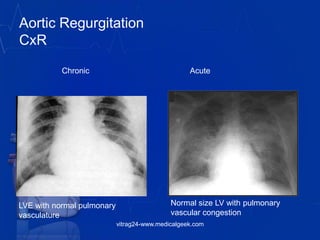 Chronic Acute
Normal size LV with pulmonary
vascular congestion
LVE with normal pulmonary
vasculature
Aortic Regurgitation
CxR
vitrag24-www.medicalgeek.com
 