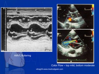 AMVL fluttering
Color Flow – top mild, bottom moderate
vitrag24-www.medicalgeek.com
 