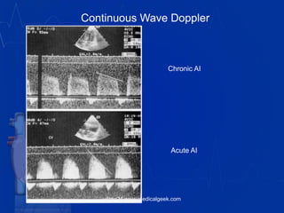 Chronic AI
Acute AI
Continuous Wave Doppler
vitrag24-www.medicalgeek.com
 