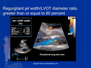 Regurgitant jet width/LVOT diameter ratio
greater than or equal to 60 percent
vitrag24-www.medicalgeek.com
 
