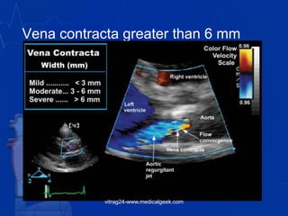Vena contracta greater than 6 mm
vitrag24-www.medicalgeek.com
 