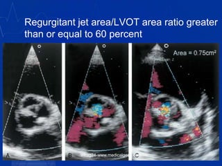 Regurgitant jet area/LVOT area ratio greater
than or equal to 60 percent
vitrag24-www.medicalgeek.com
 