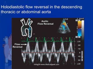 Holodiastolic flow reversal in the descending
thoracic or abdominal aorta
vitrag24-www.medicalgeek.com
 