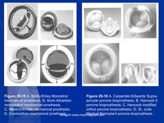 Figure 29-15 A. Björk-Shiley Monostrut
mechanical prosthesis. B. Sorin Allcarbon
monoleaflet mechanical prosthesis.
C. Medtronic-Hall mechanical prosthesis.
D. Omnicarbon mechanical prosthesis.
Figure 29-16 A. Carpentier-Edwards Supra-
annular porcine bioprosthesis. B. Hancock II
porcine bioprosthesis. C. Hancock modified
orifice porcine bioprosthesis. D. St. Jude
Medical Bioimplant porcine bioprosthesis.vitrag24-www.medicalgeek.com
 