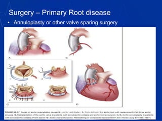 Surgery – Primary Root disease
• Annuloplasty or other valve sparing surgery
vitrag24-www.medicalgeek.com
 