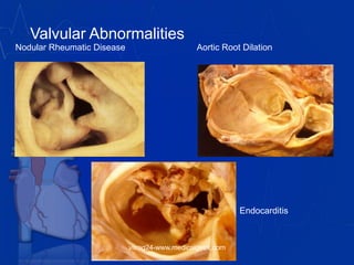 Valvular Abnormalities
Nodular Rheumatic Disease Aortic Root Dilation
Endocarditis
vitrag24-www.medicalgeek.com
 