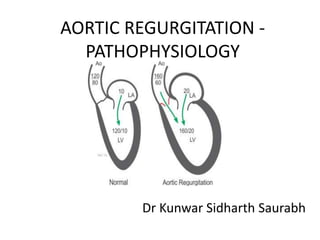 AORTIC REGURGITATION -
PATHOPHYSIOLOGY
Dr Kunwar Sidharth Saurabh
 