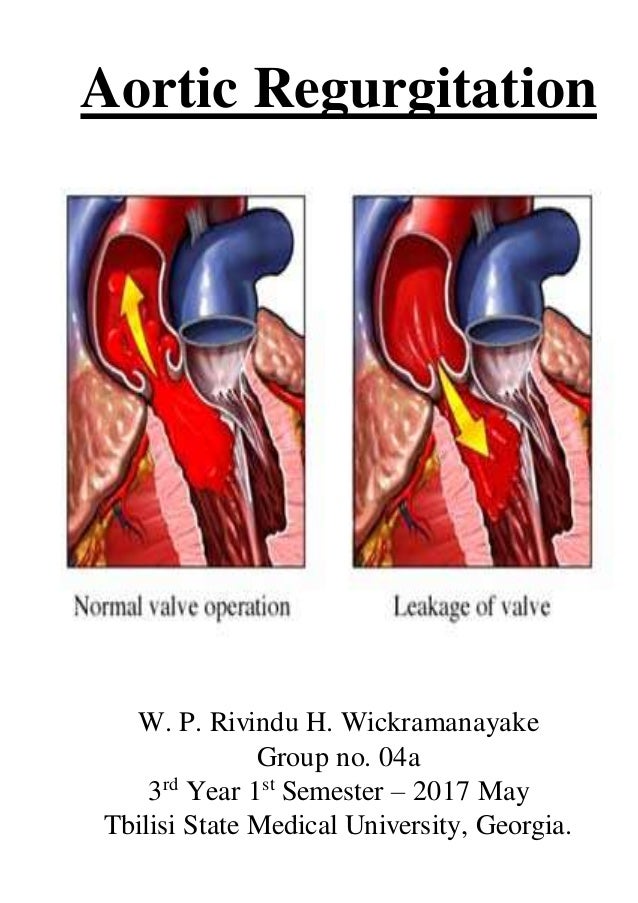 Dissertation on aortic regurgitation