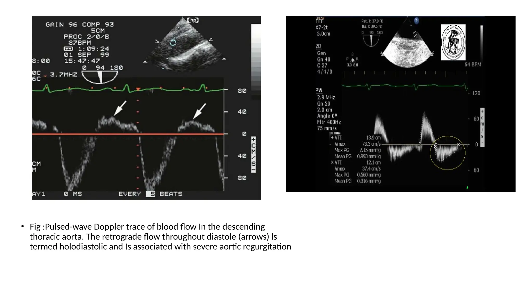 aortic regurgitation Tranesophhageal echocardiographic evaluation | PPTX