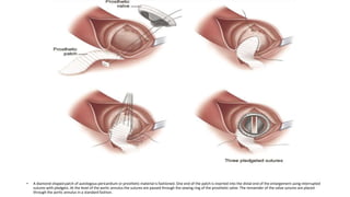 Patch Closure Aortic repair ppt | PPTX
