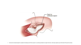 Aortic repair ppt | PPTX
