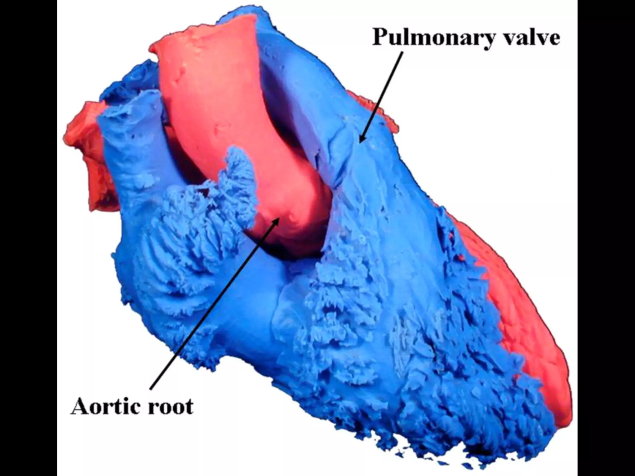 Aortic root surgical anatomy | PPT