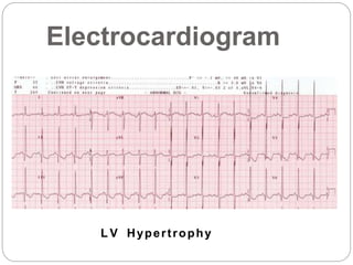 Electrocardiogram
L V Hypertrophy
 