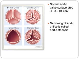  Normal aortic
valve surface area
is 03 – 04 cm2
 Narrowing of aortic
orifice is called
aortic stenosis
 