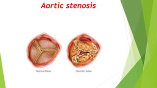 Aortic stenosis
 