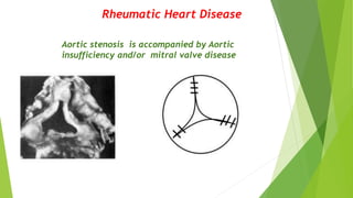Rheumatic Heart Disease
Aortic stenosis is accompanied by Aortic
insufficiency and/or mitral valve disease
 