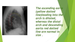 The ascending aorta
(yellow dotted
line)leading into the
arch is dilated,
whereas the distal
arch and descending
aorta red dotted
line are normal in
size .
 
