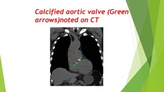 Calcified aortic valve (Green
arrows)noted on CT
 