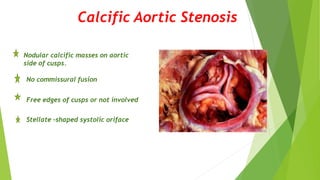 Calcific Aortic Stenosis
Nodular calcific masses on aortic
side of cusps.
No commissural fusion
Free edges of cusps or not involved
Stellate –shaped systolic oriface
 