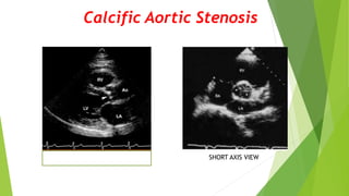 Calcific Aortic Stenosis
LONG AXIS VIEW SHORT AXIS VIEW
 
