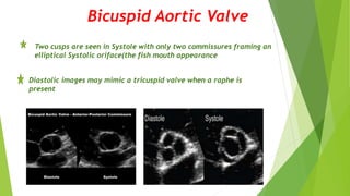 Bicuspid Aortic Valve
Two cusps are seen in Systole with only two commissures framing an
elliptical Systolic oriface(the fish mouth appearance
Diastolic images may mimic a tricuspid valve when a raphe is
present
 