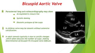 Bicuspid Aortic Valve
Parasternal long axis echocardiography may show
An Asymmetric closure line
Systolic doming
Diastolic prolapse of the cusps
In children valve may be stenotic without extensive
calcification.
In adult stenosis typically is due to calcific changes
,which often obscures the number of cusps ,making
determination of bicuspid VS tricuspid valve difficult.
 