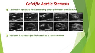 Calcific Aortic Stenosis
Calcification of bicuspid valve,the severity can be graded semi quantitavely as
The degree of valve calcification is predictor of clinical outcome.
 
