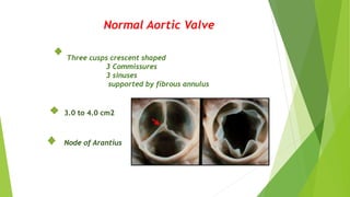 Normal Aortic Valve
Three cusps crescent shaped
3 Commissures
3 sinuses
supported by fibrous annulus
3.0 to 4.0 cm2
Node of Arantius
 