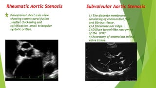Rheumatic Aortic Stenosis
Parasternal short axis view
showing commissural fusion
,leaflet thickening and
calcification ,small triangular
systolic orifice.
Subvalvular Aortic Stenosis
1) The discrete membrane
consisting of endocardial fold
and fibrous tissue.
2) A fibromuscular ridge.
3) Diffuse tunnel-like narrowing
of the LVOT.
4) Accessory of anomalous mitral
valve tissue.
 