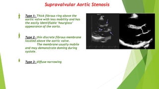 Supravalvular Aortic Stenosis
Type 1- Thick fibrous ring above the
aortic valve with less mobility and has
the easily identifiable ‘hourglass’
appearance of the aorta.
Type 2- thin discrete fibrous membrane
located above the aortic valve.
The membrane usually mobile
and may demonstrate doming during
systole.
Type 3- diffuse narrowing
 