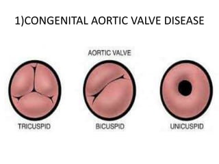1)CONGENITAL AORTIC VALVE DISEASE
 