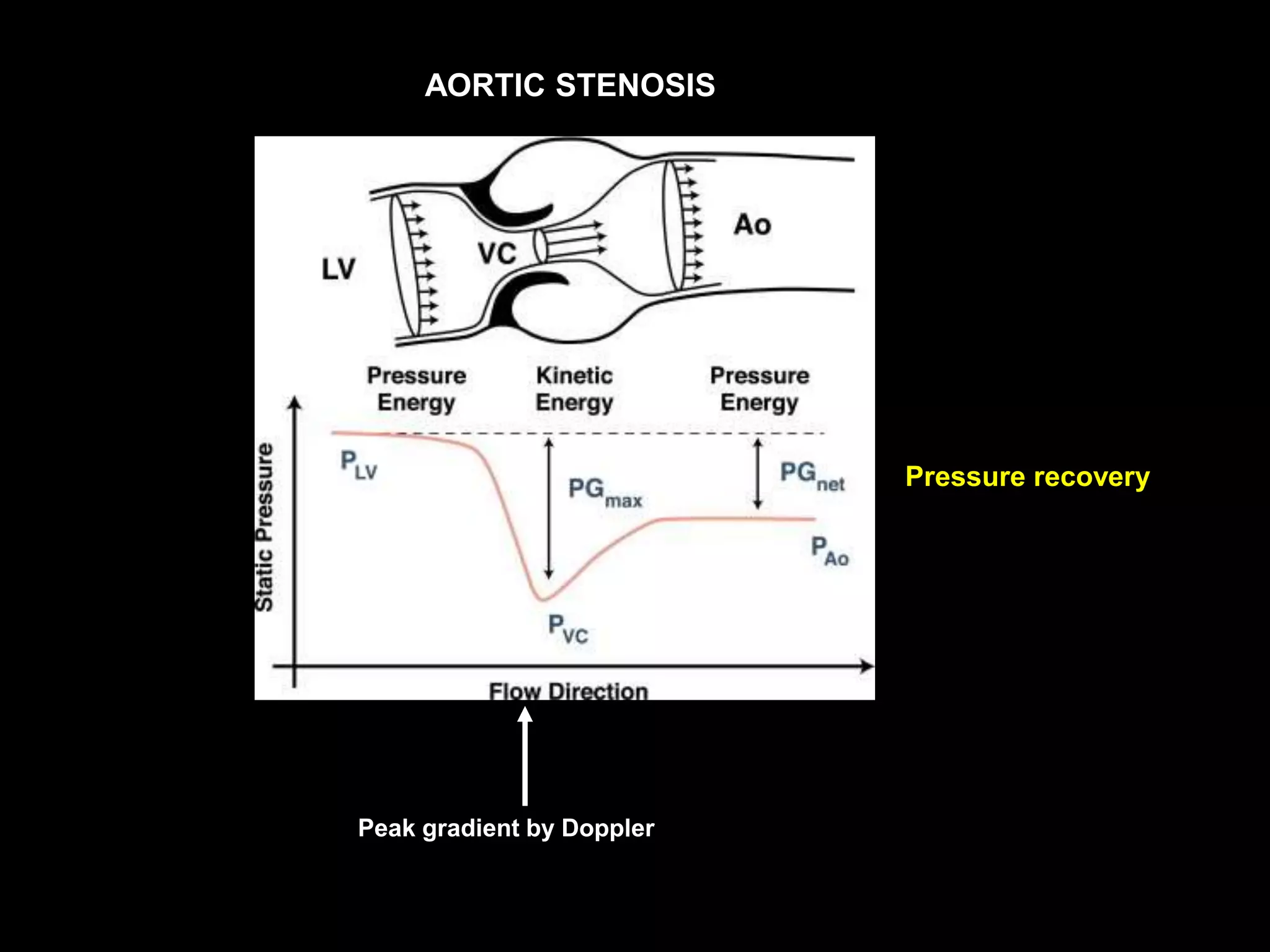 AORTIC STENOSIS
Peak gradient by Doppler
Pressure recovery
 
