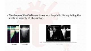 Cwd Levels Aortic stenosis Diagnosis and grading .pptx