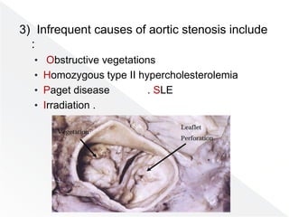 3) Infrequent causes of aortic stenosis include
:
• Obstructive vegetations
• Homozygous type II hypercholesterolemia
• Paget disease . SLE
• Irradiation .
 