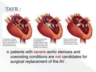  patients with severe aortic stenosis and
coexisting conditions are not candidates for
surgical replacement of the AV .
 