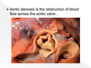  Aortic stenosis is the obstruction of blood
flow across the aortic valve .
 