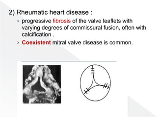 2) Rheumatic heart disease :
› progressive fibrosis of the valve leaflets with
varying degrees of commissural fusion, often with
calcification .
› Coexistent mitral valve disease is common.
 