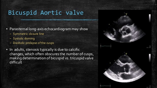 Echocardiography Of Aortic Stenosis