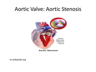Aortic Valve: Aortic Stenosis
en.wikipedia.org
 
