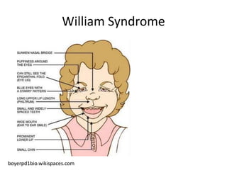 William Syndrome
boyerpd1bio.wikispaces.com
 