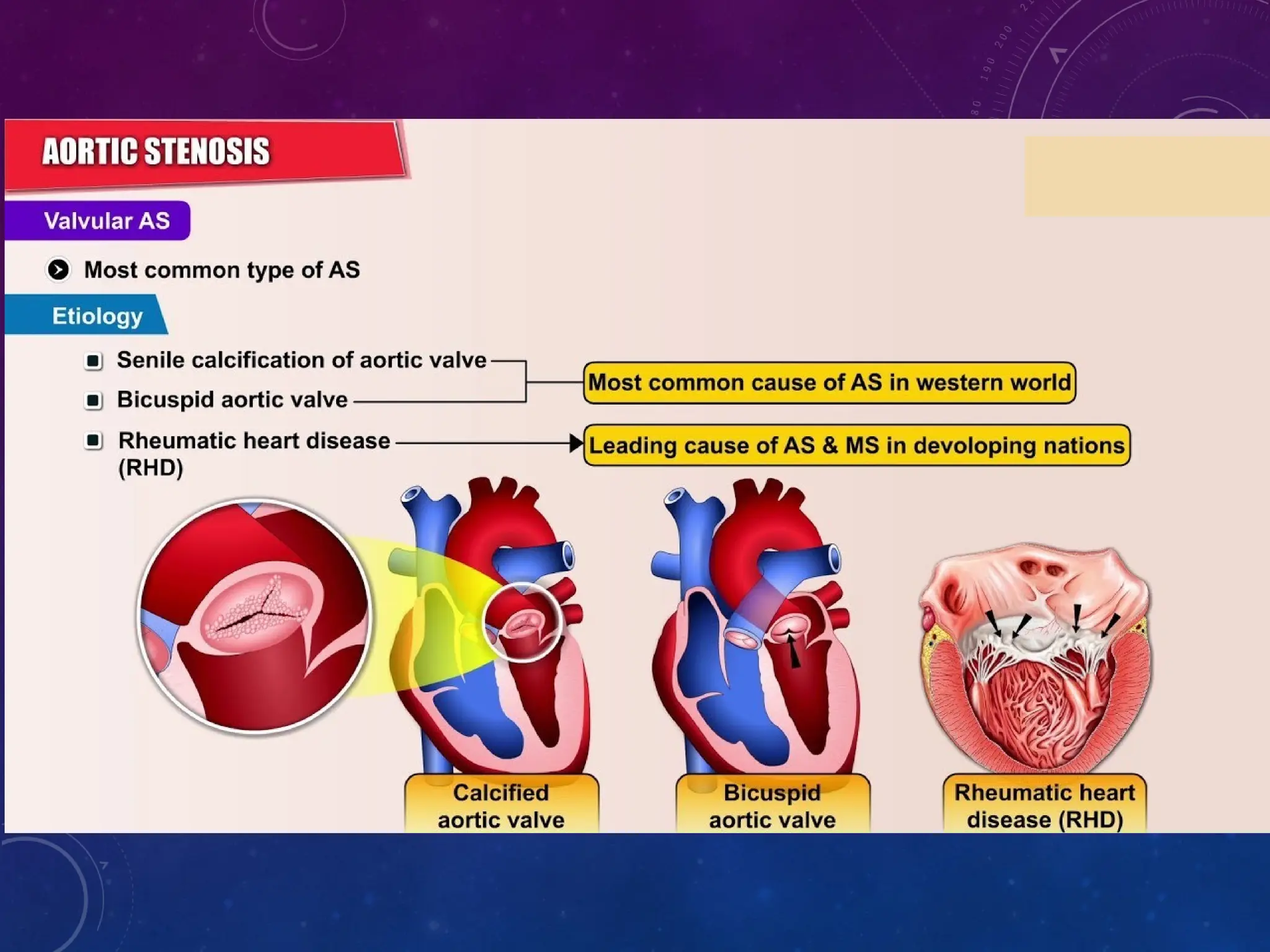 Comparing Aortic Stenosis to Other Pollution-Linked Heart Issues Comparing Aortic Stenosis to Other Pollution-Linked Heart Issues